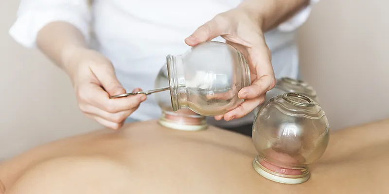 fire cupping