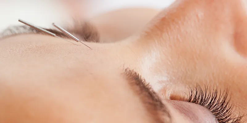 forehead acupuncture